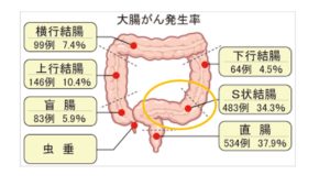 S状結腸ガン